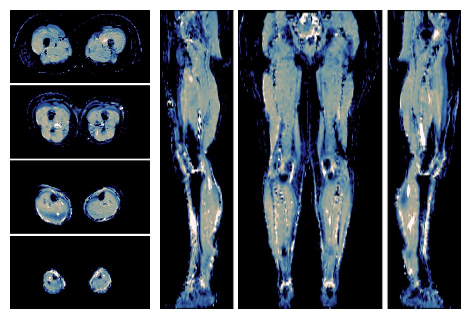 IVIM corrected whole leg muscle mean diffusivity obtained from diffusion tensor imaging.